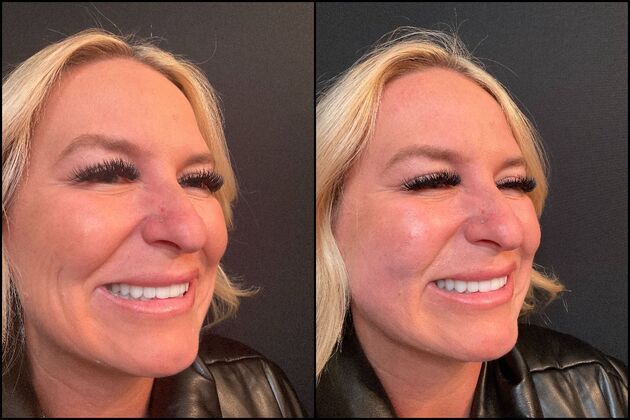 Collagen Bio-Stimulators  Case 2- Collagen Bio-stimulators with Hyper-dilute Radiesse 