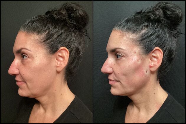 PDO Threads : Case 1- PDO Thread Lift - Before & After