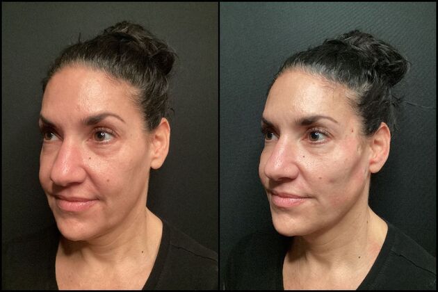 PDO Threads : Case 1- PDO Thread Lift - Before & After