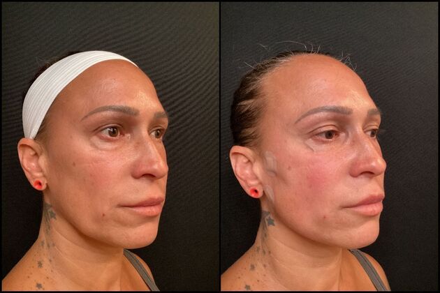 PDO Threads  Case 3- PDO Thread Lift