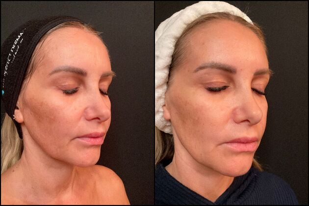 Chemical Peels Case