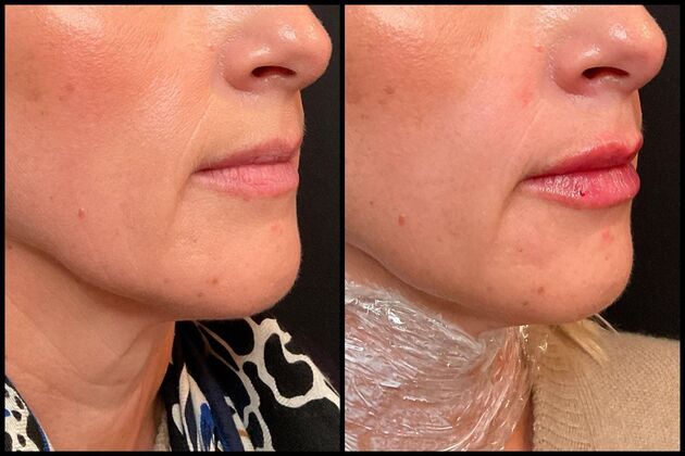 Dermal Fillers Case 3 - Signature Subtle Lip Filler