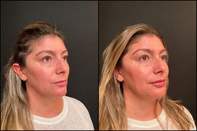 Dermal Fillers Case 7 - Lip Filler