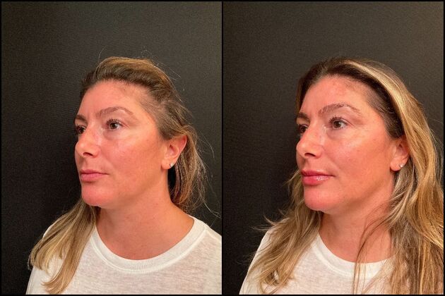 Dermal Fillers: Case 7 - Lip Filler - Before