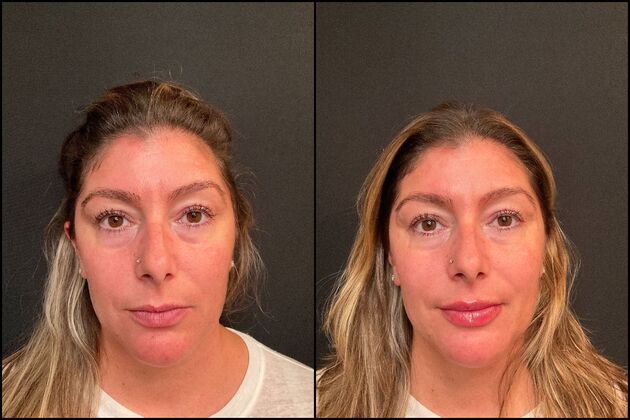 Dermal Fillers: Case 7 - Lip Filler - Before