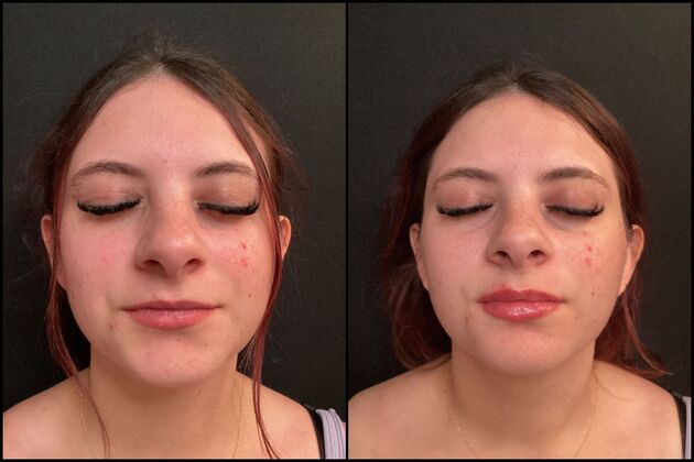 Dermal Fillers Case 8 - Lip Filler