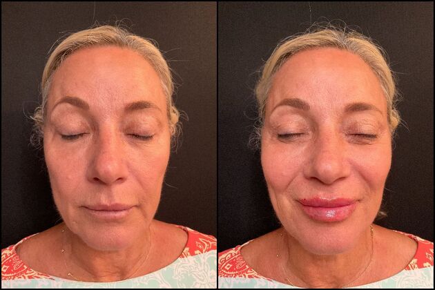 Dermal Fillers Case 9 - Lip Filler