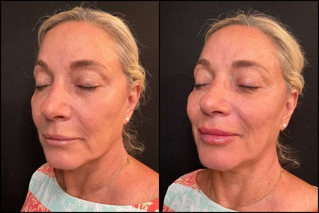 Dermal Fillers: Case 9 - Lip Filler - Before