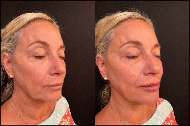 Dermal Fillers: Case 9 - Lip Filler - Before