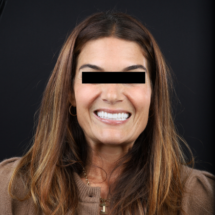 No Prep Porcelain Veneers Susan - After