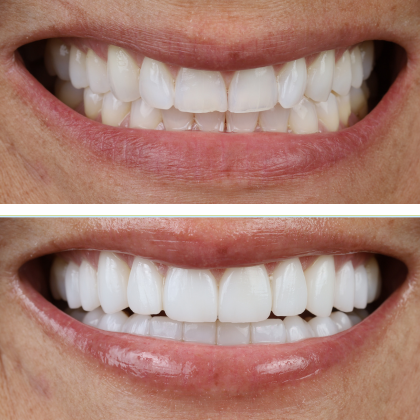 No Prep Porcelain Veneers Susan - Before