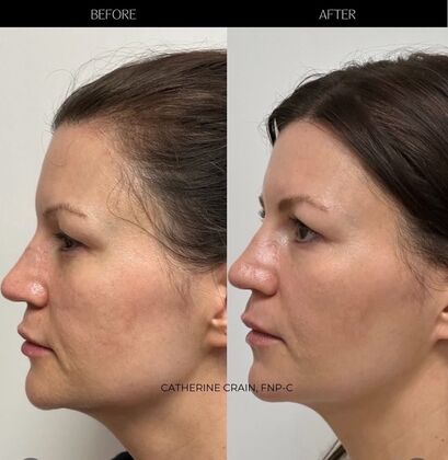 Facial Laser Resurfacing Case 5 (1336346) - After
