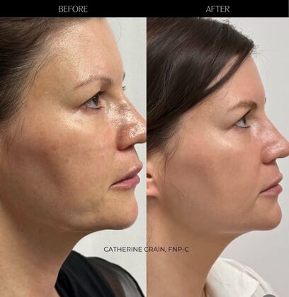 Facial Laser Resurfacing: Case 5 (1336346) - Before