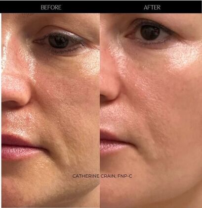 Facial Laser Resurfacing Case 5 (1336346) - Before
