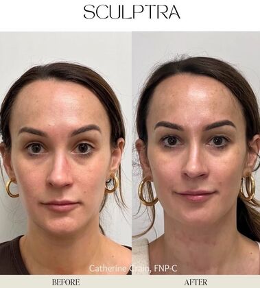 Injectables Minimally-Invasive / Fillers: Case 21 (4408628) - Before and After
