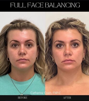 Injectables Minimally-Invasive / Fillers: Case 22 (6625098) - Before & After