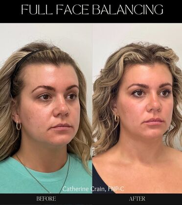 Injectables Minimally-Invasive / Fillers: Case 22 (6625098) - Before & After
