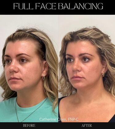Injectables Minimally-Invasive / Fillers: Case 22 (6625098) - Before & After
