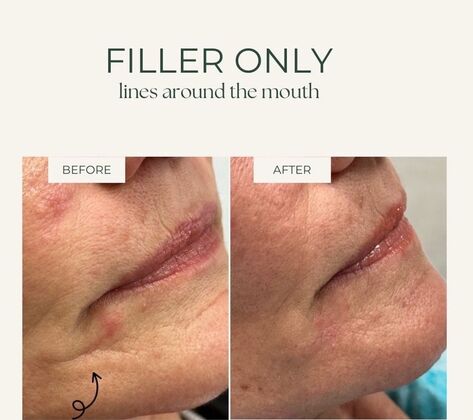 Injectables Minimally-Invasive / Fillers: Case 23 (3339641) - Smoother lines