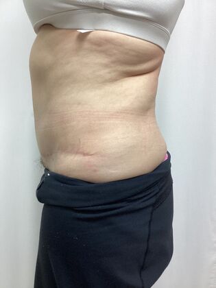 Body Tummy Tuck / Abdominoplasty: Case 29 (3822603) - Before