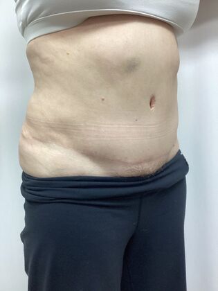 Body Tummy Tuck / Abdominoplasty: Case 29 (3822603) - After