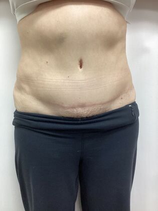 Body Tummy Tuck / Abdominoplasty Case 29 (3822603) - After