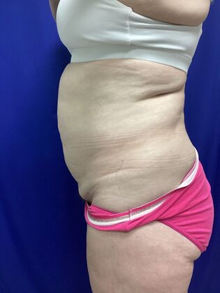 Body Tummy Tuck / Abdominoplasty: Case 29 (3822603) - Before