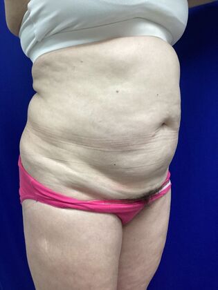 Body Tummy Tuck / Abdominoplasty: Case 29 (3822603) - Before
