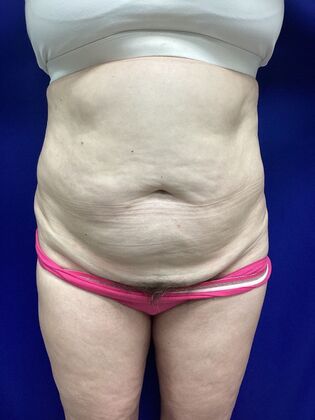 Body Tummy Tuck / Abdominoplasty Case 29 (3822603) - Before