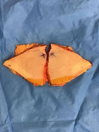 Body Tummy Tuck / Abdominoplasty: Case 29 (3822603) - Before