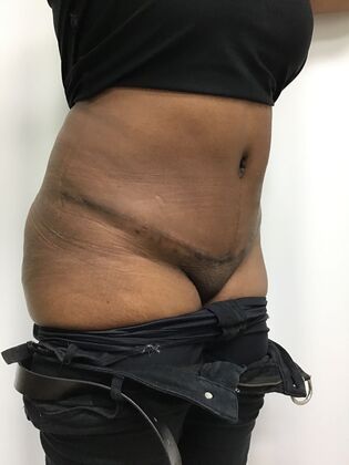 Body Tummy Tuck / Abdominoplasty Case 30 (33941) - After