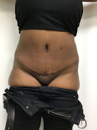 Body Tummy Tuck / Abdominoplasty: Case 30 (33941) - After