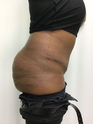 Body Tummy Tuck / Abdominoplasty: Case 30 (33941) - After