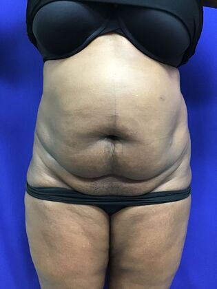 Body Tummy Tuck / Abdominoplasty: Case 30 (33941) - Before