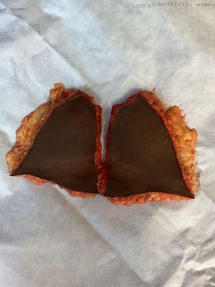 Body Tummy Tuck / Abdominoplasty: Case 30 (33941) - Discarded skin and fat from the lower abdomen, extending from the pubic area to the belly button vertically, and from one side to the other across