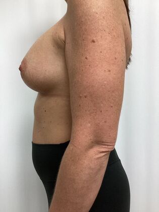 Breast Augmentation : Case 87 (35984) - After