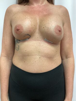 Breast Augmentation  Case 87 (35984) - After