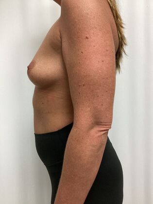 Breast Augmentation : Case 87 (35984) - Before
