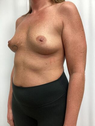 Breast Augmentation : Case 87 (35984) - Before