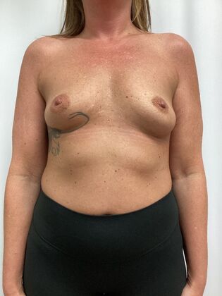 Breast Augmentation  Case 87 (35984) - Before