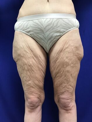 Thigh Reduction / Thighplasty: Case 3 (2905830) - Before