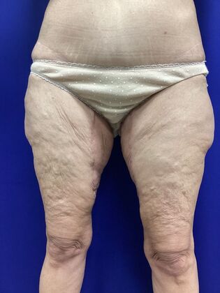 Thigh Reduction / Thighplasty: Case 3 (2905830) - After