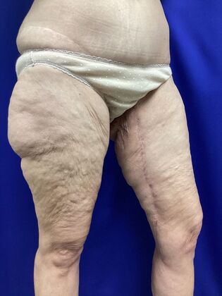 Thigh Reduction / Thighplasty: Case 3 (2905830) - After, scar detail