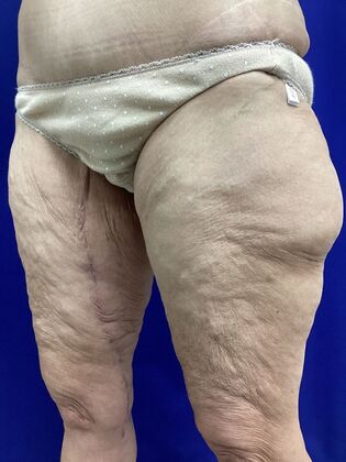 Thigh Reduction / Thighplasty: Case 3 (2905830) - After, scar detail