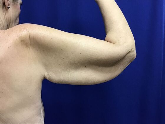 Arm Contouring / Lift: Case 10 (2905830) - Before, back view
