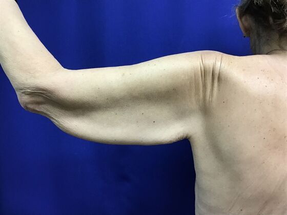 Arm Contouring / Lift: Case 10 (2905830) - Before, back view