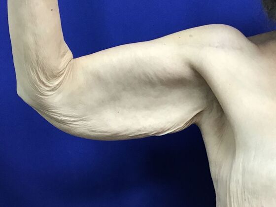 Arm Contouring / Lift: Case 10 (2905830) - Right front, before
