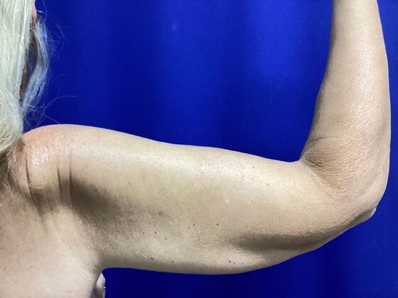 Arm Contouring / Lift: Case 10 (2905830) - After, back view