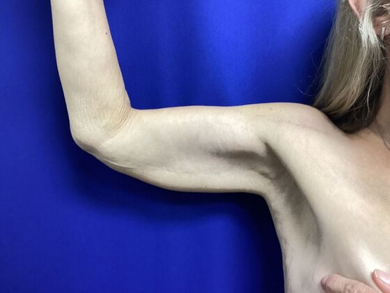 Arm Contouring / Lift: Case 10 (2905830) - Right front, after