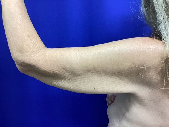 Arm Contouring / Lift: Case 10 (2905830) - After, back view